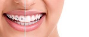 3 lý do bạn nên chọn niềng răng invisalign thay vì niềng răng mắc cài 1