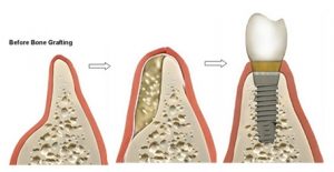 Bị tiêu xương hàm có trồng implant được không? 2