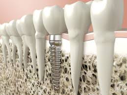 Cấy ghép răng implant nha khoa 2