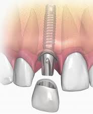 Cấy ghép răng implant nha khoa 1
