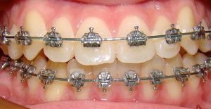 Có nên niềng răng mắc cài kim loại không