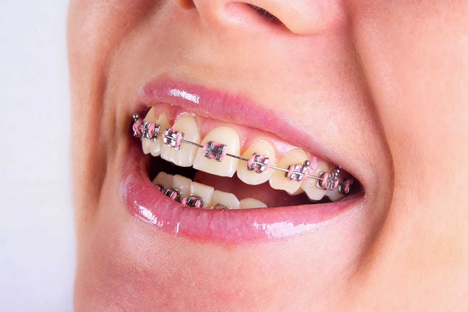 Có nên niềng răng mắc cài kim loại hay không? 3