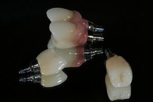 Implant nha khoa phương pháp cấy ghép răng hiệu quả 1