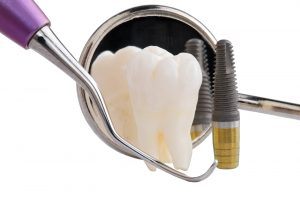 Implant và chi phí trồng răng implant 2