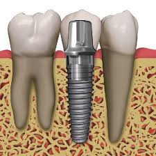 Khi nào nên chọn lựa trồng răng implant? 2