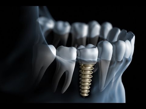 Khi nào nên chọn lựa trồng răng implant? 1
