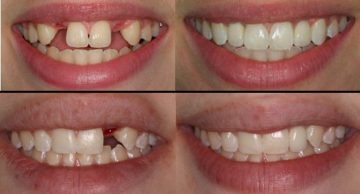 Mất bao lâu hoàn tất quá trình điều trị cấy ghép implant? 3