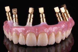 So sánh răng cấy ghép và răng tự nhiên