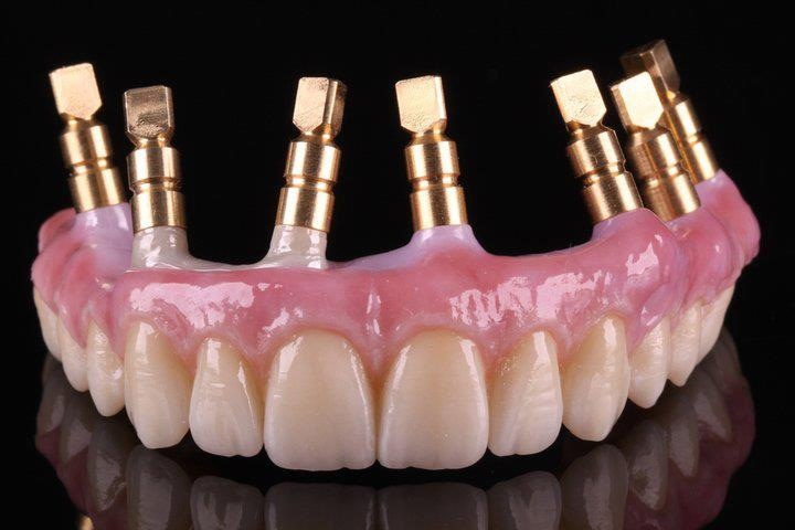So sánh răng cấy ghép và răng tự nhiên 1