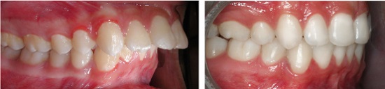 Các phương pháp điều trị răng hô 1
