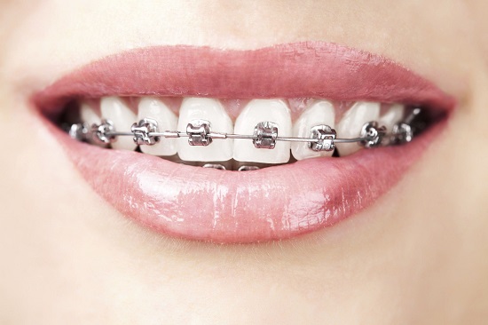 Các phương pháp điều trị răng hô 2