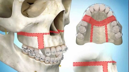 Các phương pháp điều trị răng hô 3