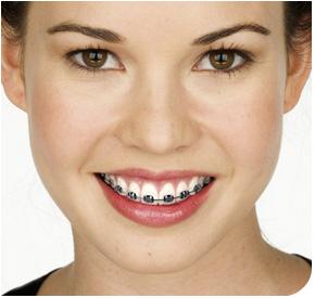 Các yếu tố ảnh hưởng đến chi phí niềng răng 1