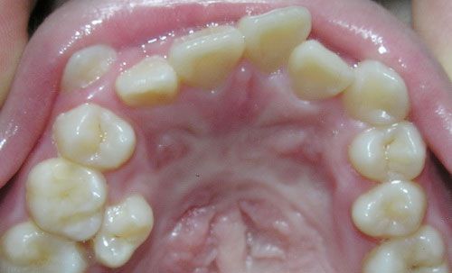 Cải thiện tình trạng răng mọc không đều đặn 1