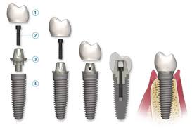 Trình tự các thủ tục trồng răng implant 2