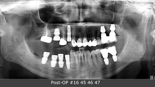 Trồng răng implant khi mất nhiều răng 1