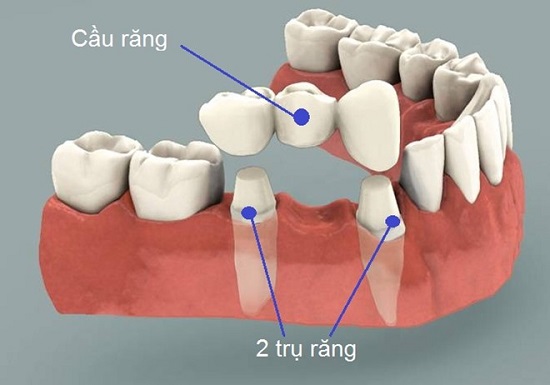 Các phương pháp trồng răng giả 2