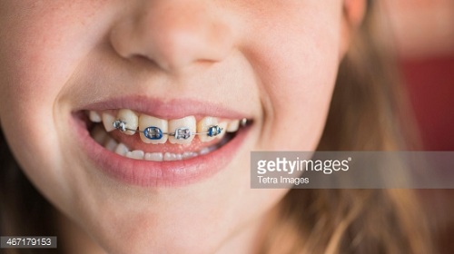 Các trường hợp răng miệng cần được niềng răng sớm 1