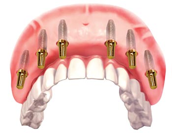 Cắm implant khi mất răng toàn hàm có tốt không? 2