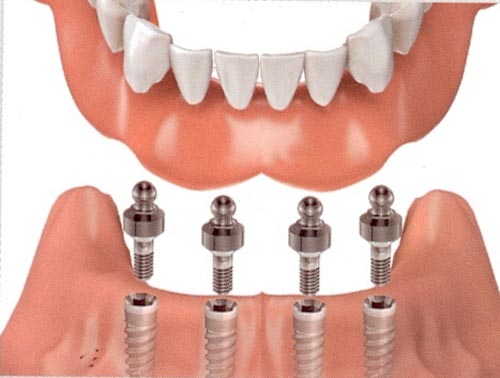 Cắm implant khi mất răng toàn hàm có tốt không? 1