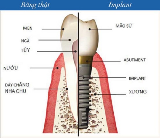 Cấu tạo của răng Implant 1