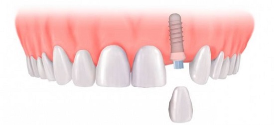 Cấy ghép implant để khắc phục móm do mất răng 2