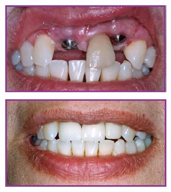 Cấy ghép implant để khắc phục móm do mất răng 3