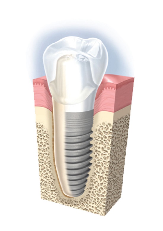 Cấy ghép răng implant có lâu không? 1