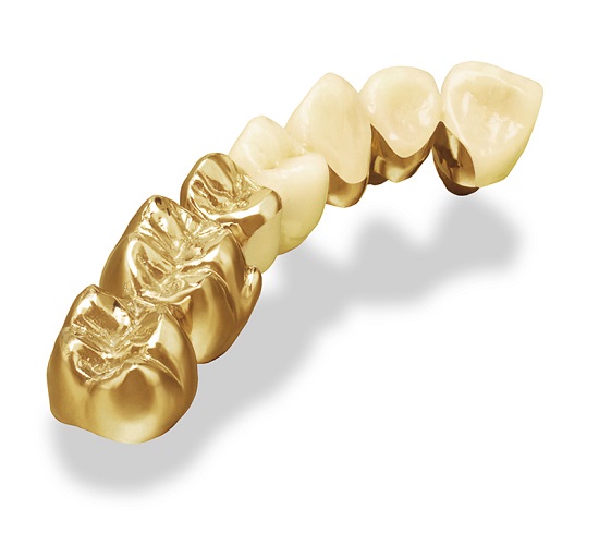 Cấy ghép răng implant giá bao nhiêu tiền? 1