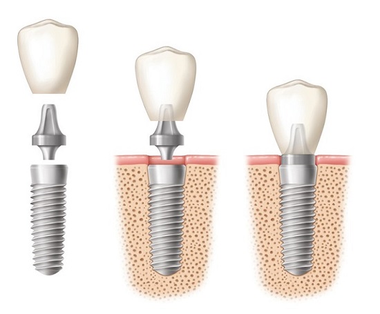 Cấy ghép răng implant giá bao nhiêu tiền? 