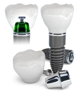 Khám phá quy trình trồng răng implant 1