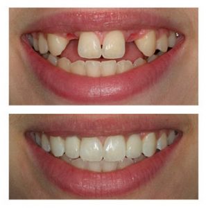 Khám phá quy trình trồng răng implant 2