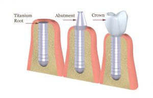 Mất răng và các giải pháp phục hình răng thẩm mỹ 2