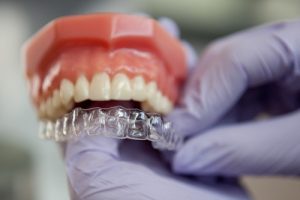 một vài lưu ý nhỏ khi niềng răng invisalign