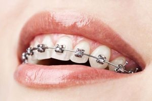Niềng răng có lợi hay có hại? 2