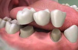 Phân loại phục hình răng giả cố định