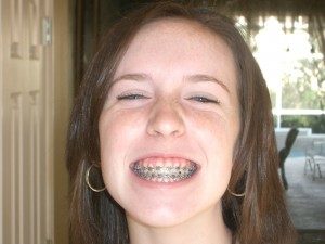 Phương pháp niềng răng được thực hiện như thế nào ?