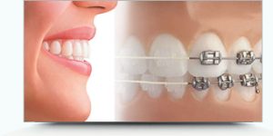 Phương pháp niềng răng được thực hiện như thế nào? 2