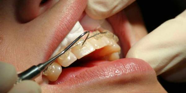 Tìm hiểu quy trình niềng răng an toàn hiệu quả 2