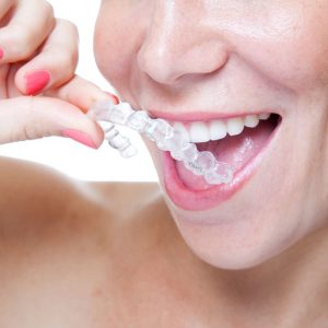 Tìm hiểu quy trình niềng răng an toàn, hiệu quả