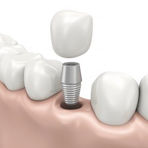 Trồng răng implant kéo dài được bao lâu? 1