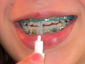 Chăm sóc răng miệng như thế nào khi niềng răng? 2