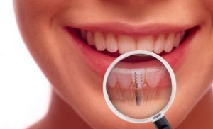 Giải pháp phục hình răng giả ngăn ngừa tiêu xương hàm 1