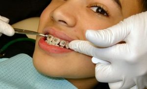 Khi niềng răng mắc cài cần chú ý những gì? 2