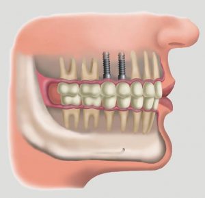 Nhổ răng sâu có ảnh hưởng xấu hay không? 1