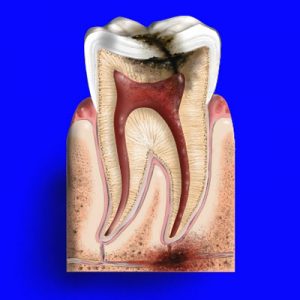 Nhổ răng sâu có ảnh hưởng xấu hay không? 2