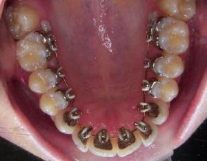 Những mặt có lợi khi niềng răng mặt lưỡi 2