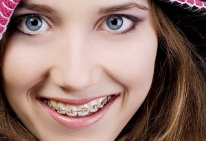 Niềng răng một hàm khi bị hô hiệu có quả không? 1