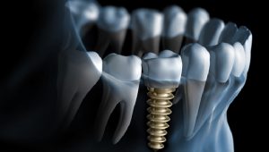 Phục hình răng cố định implant đảm bảo chịu lực tốt 1
