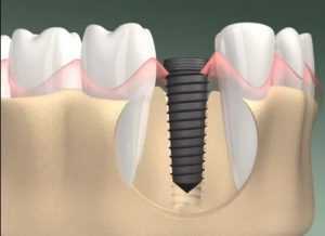 Phục hình răng cố định implant đảm bảo chịu lực tốt 2